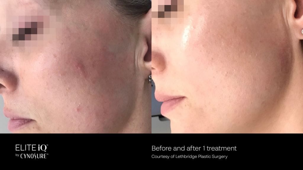 Before & After Photo of the side view of a woman's face after 1 laser facial with Elite iQ laser