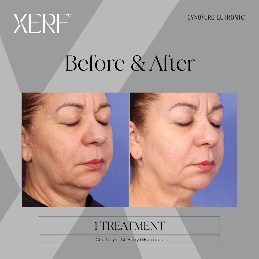 XERF Before and after photos : Facial skin tightening treatment after 1 treatment session