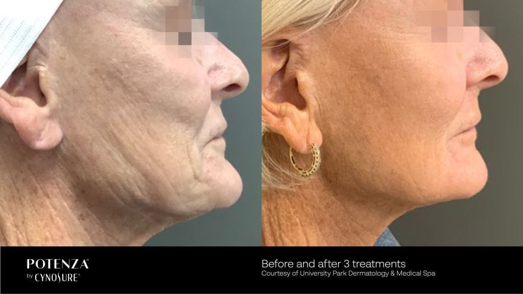 Potenza Before After Photos for Skin Laxity on face