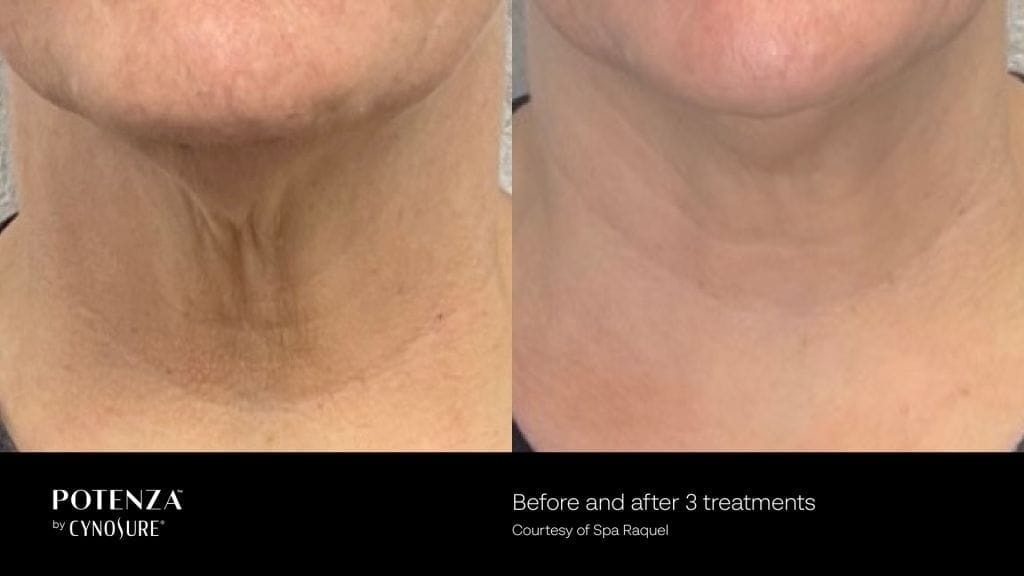 Potenza Before and After Photos for Sagging Neck Skin