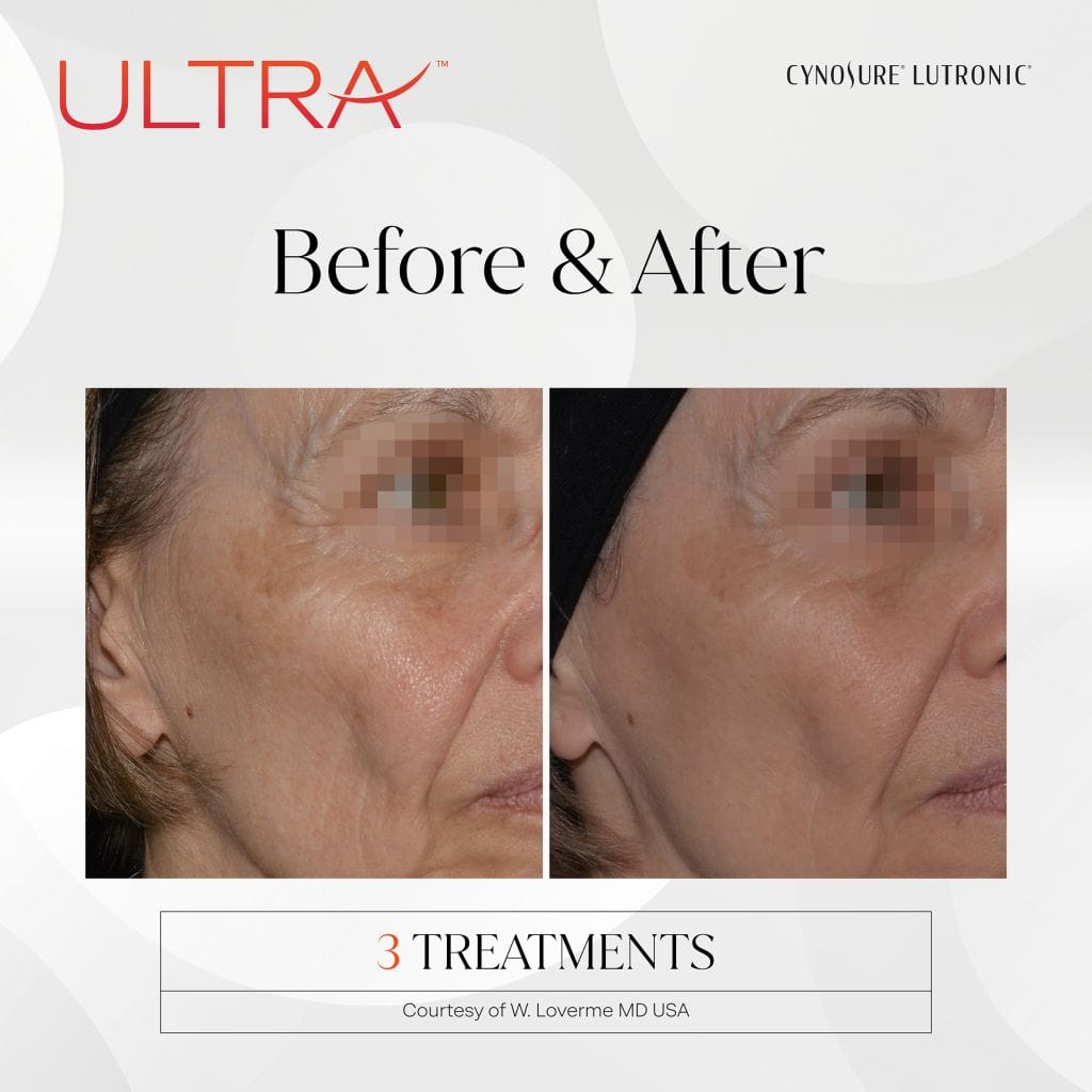 Before and after photos of older woman after undergoing 3 treatments of Ultra laser skin resurfacing 