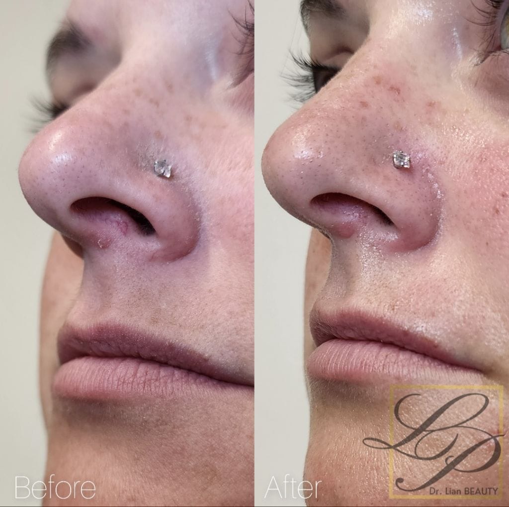 Laser skin rejuvenation Before & After Photos: vascular lesion removal on nose using the Elite iQ laser at Dr. Lian Beauty medical aesthetic clinic in Limoges, Ontario
