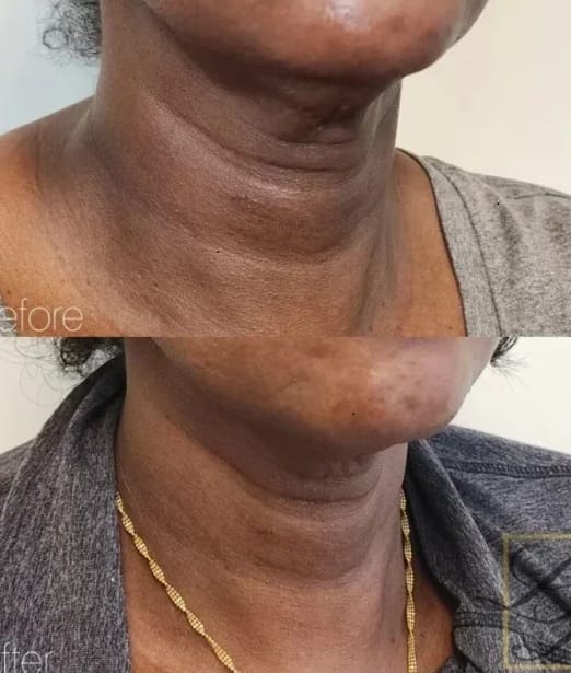 Before and after Potenza Rf Microneedling Treatment at Dr Lian Beauty in Eastern Ontario