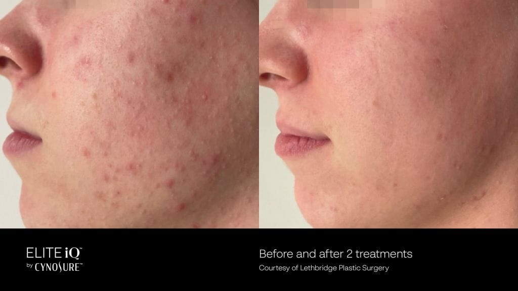 Before and after photos of acne skin rejuvenation treatment using the cynosure lutronic elite iQ laser