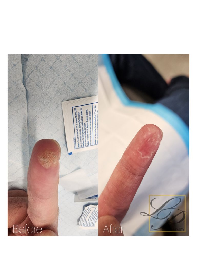 Finger Wart removal with Plexr treatment