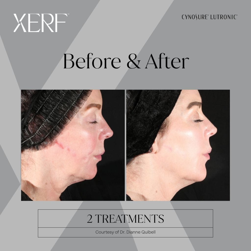 XERF before and after photos: Facial skin tightening after 2 treatments with Cynosure XERF