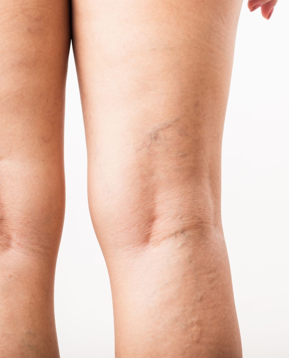 Varicose and spider veins behind the knees in a white woman