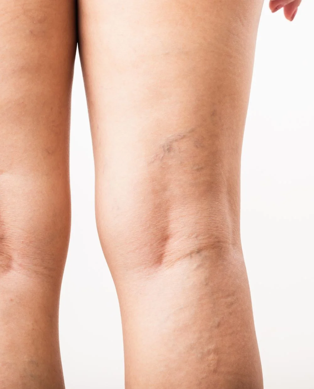Varicose and spider veins behind the knees in a white woman
