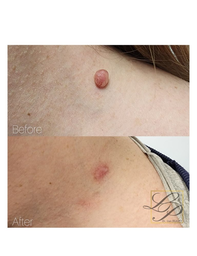 Before and after photos of mole removal with Plexr treatment