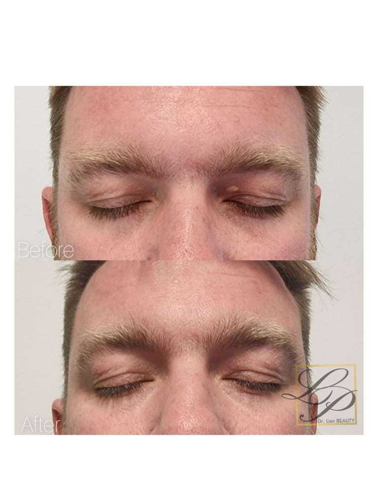 Before and after photos of Xanthelasma removal with Plexr