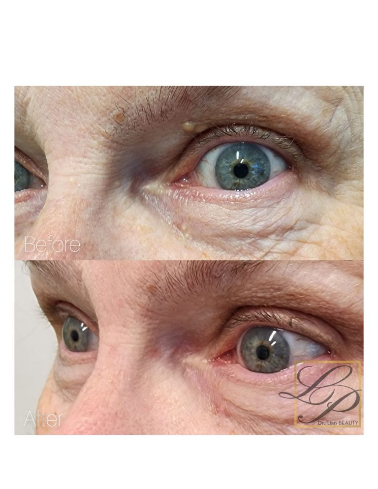 Facial Mole removal with Plexr treatment