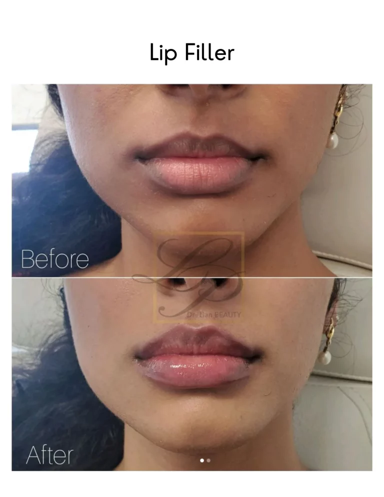 Full Lips before and after dermal fillers