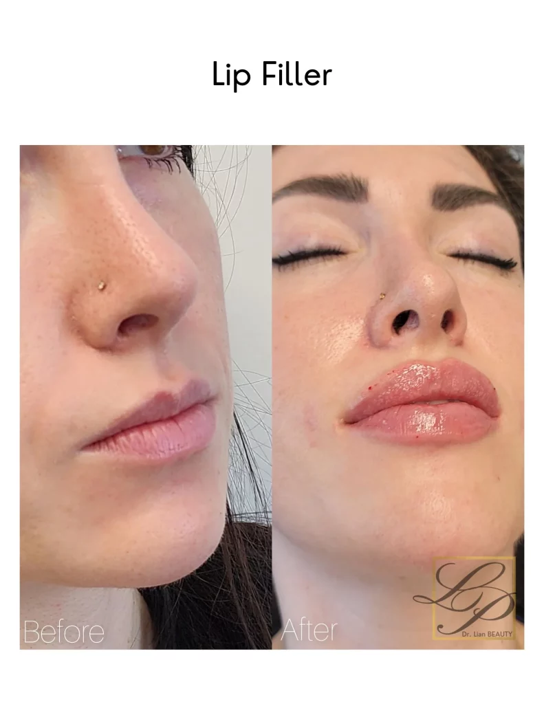 closed eyes with full lips before and after injectable dermal fillers