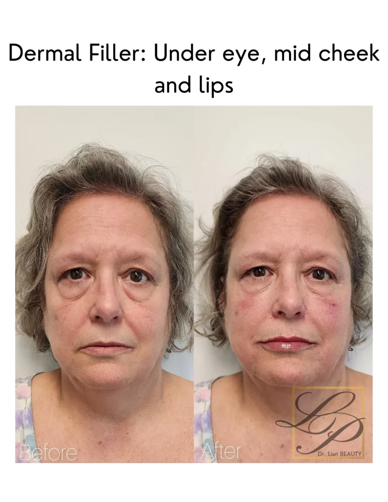 Older Woman before and after facial fillers