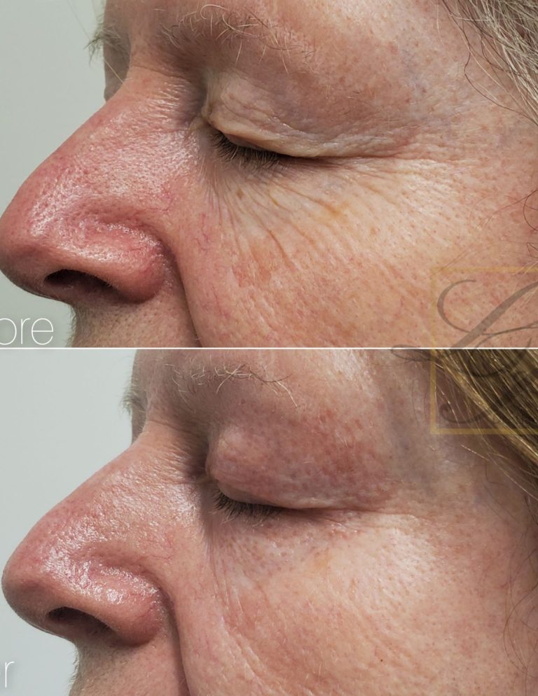 Woman's facial wrinkles removal with plexr treatment in before and after photos