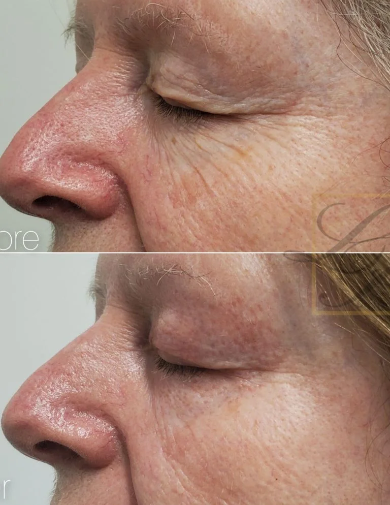 Woman's facial wrinkles removal with plexr treatment in before and after photos