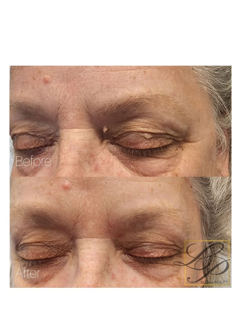 Before and after photos of Plexr skin tag removal