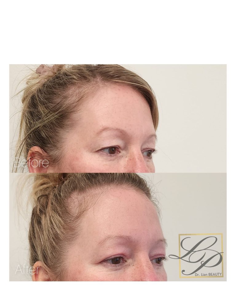 Before and after photos of Upper eyelid lift with Plexr treatment