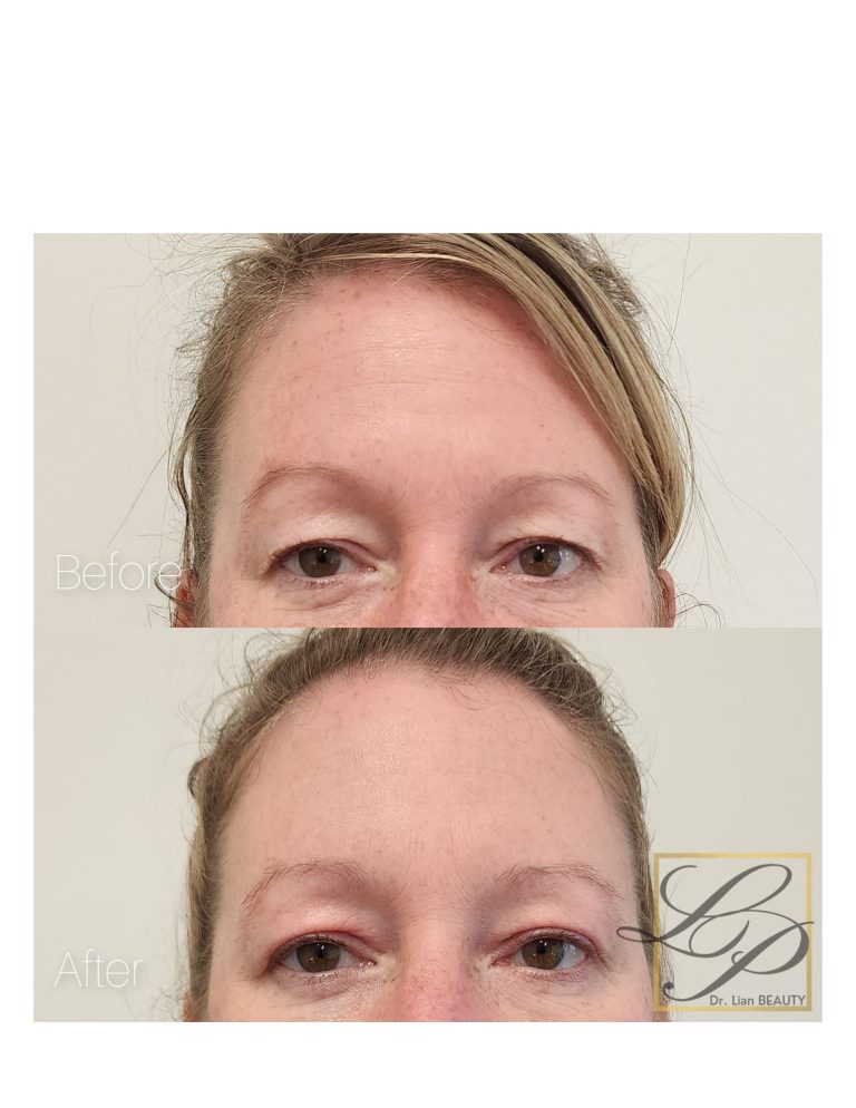 Before and after photos of Upper Eyelids lift using Plexr treatment