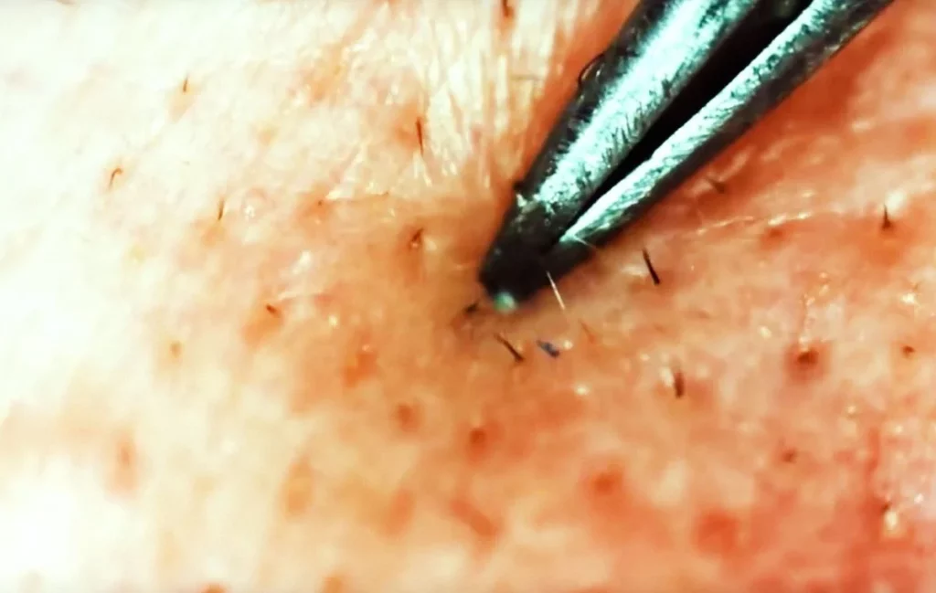 a scissors tip placed on a skin with ingrown hairs 