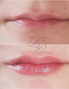 Close up shot of before and after lip fillers