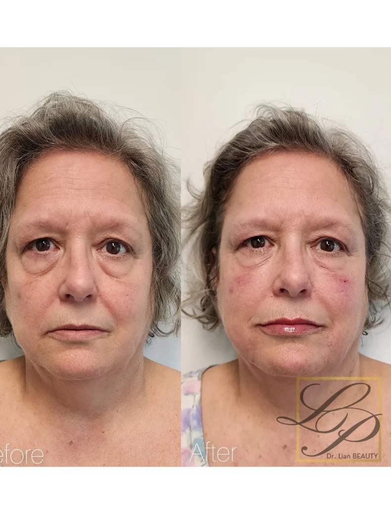 avant et après les injections de comblement dermique pour le contour des yeux, le milieu des joues et les lèvres