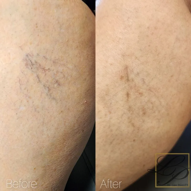Before and after Laser spider vein treatment 