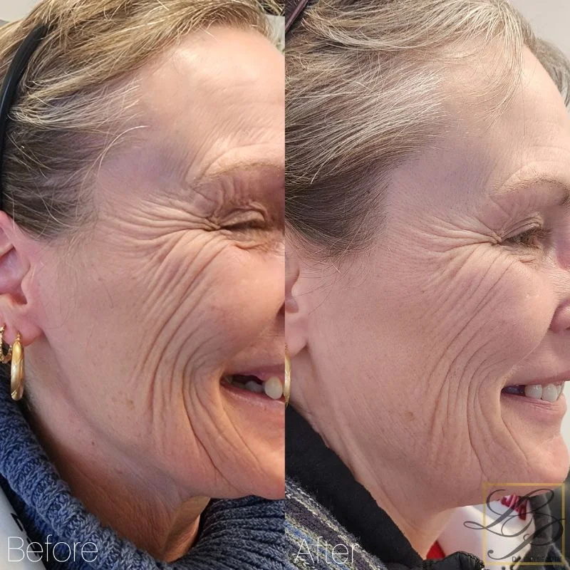 Before and after one laser facial showing wrinkle reduction after 1 session
