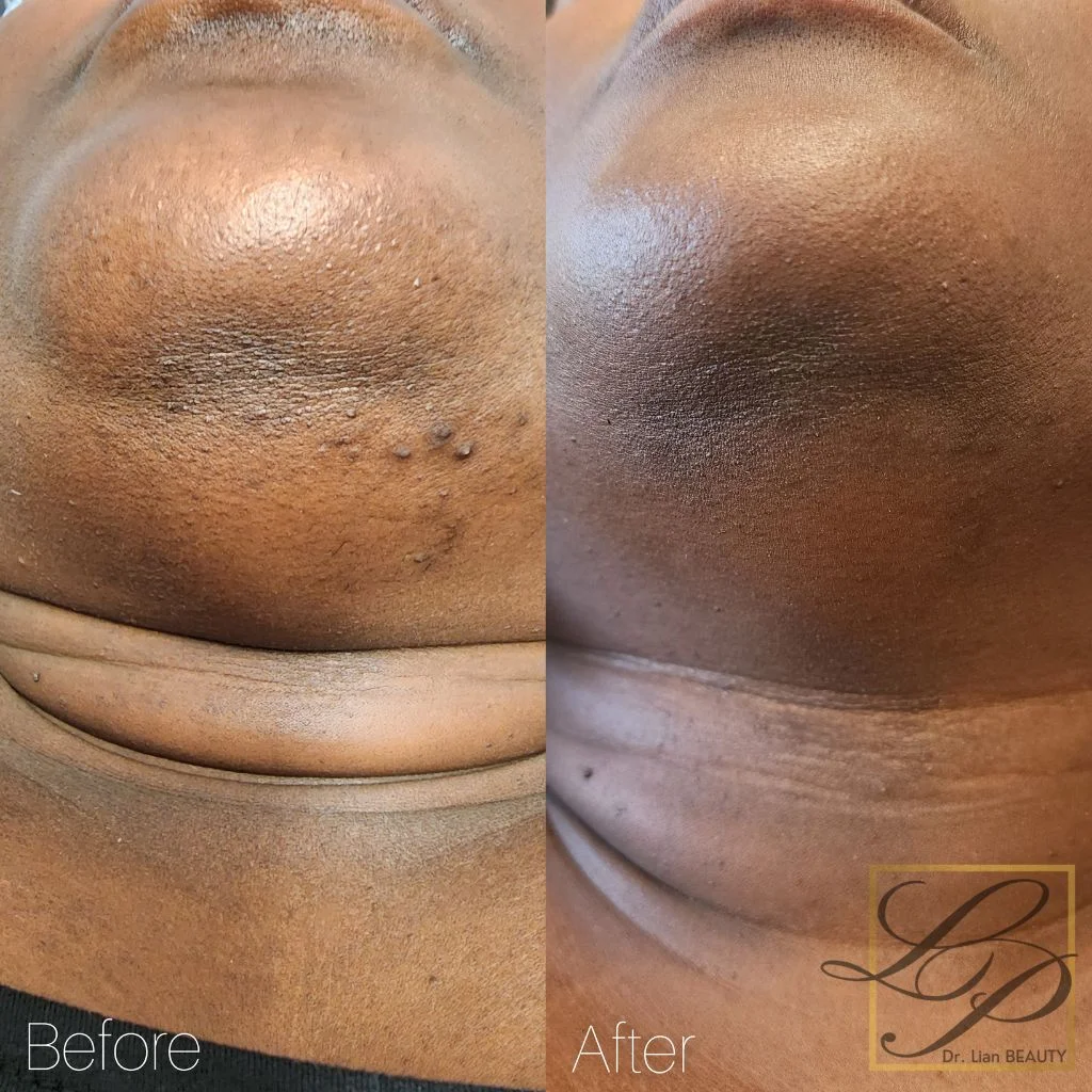 Before and after laser hair removal of chin and neck