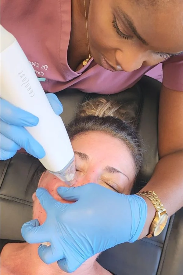 Woman undergoing potenza microneedling treatment with fusion tip
