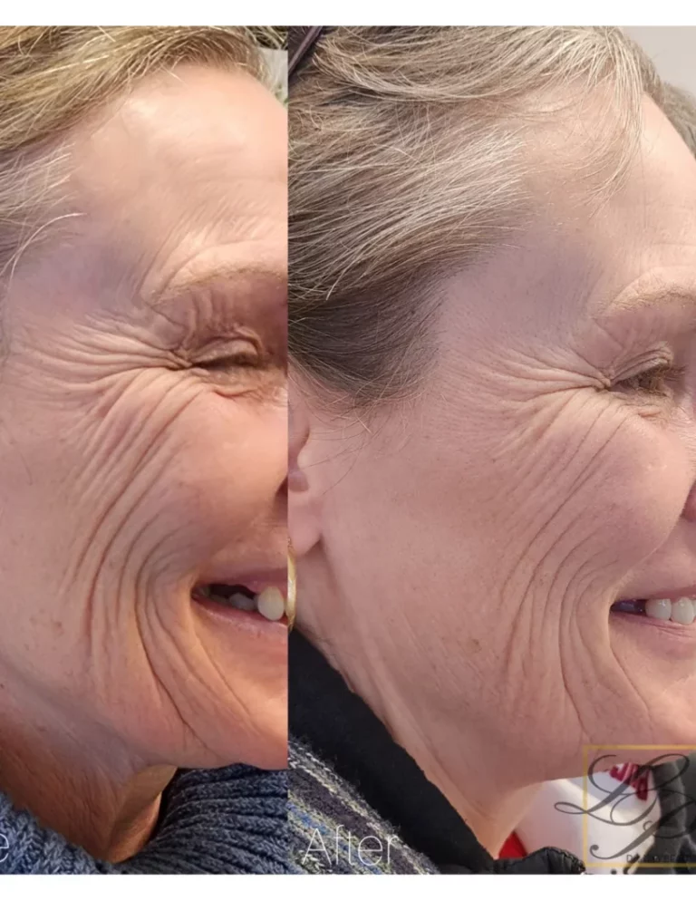 Before and after of laser facial near Ottawa at Dr Lian Beauty
