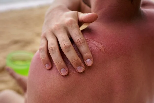 man applying lotion on sunburned skin at the beach