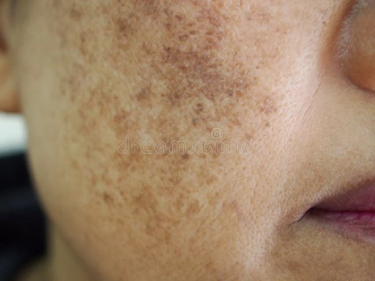 Middled aged woman with facial melasma