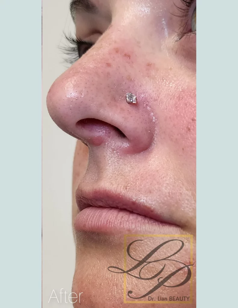 After nose vein treatment