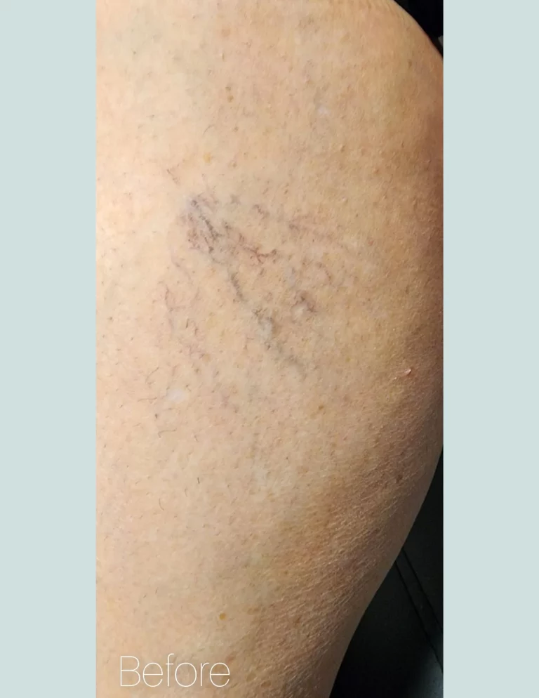 Before photo of spider vein treatment