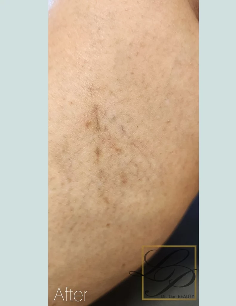 After photo of spider vein treatment