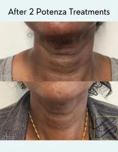 Potenza rf microneedling treatment Before and after photos showing the front view of a black woman's neck
