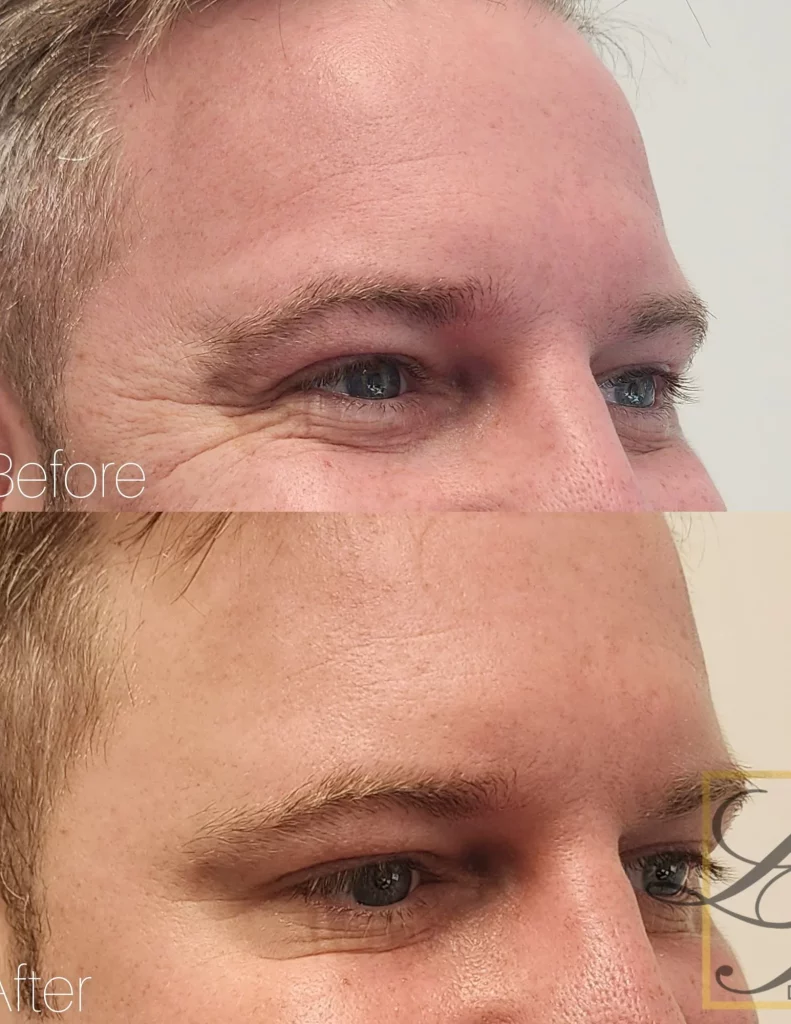closeup before and after photos of crow's feet treatment with Dysport