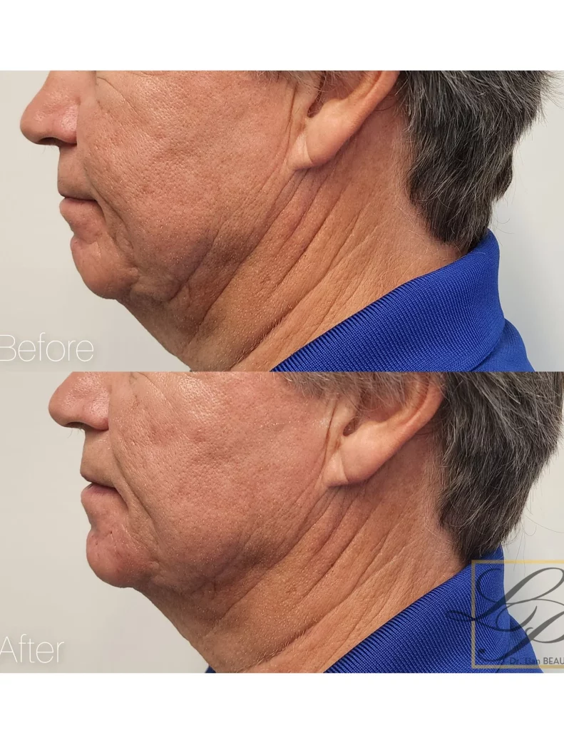 Older white man's Before and after photo of jawline and chin fillers