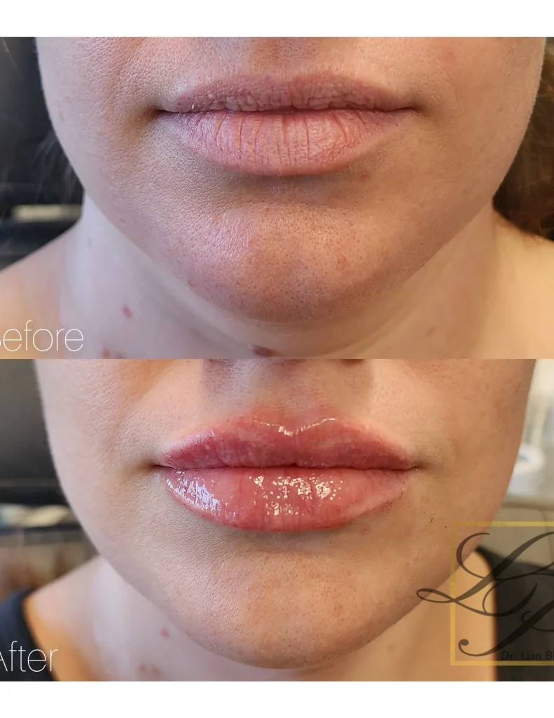 Before and after Lip fillers at Dr. Lian Beauty near Ottawa