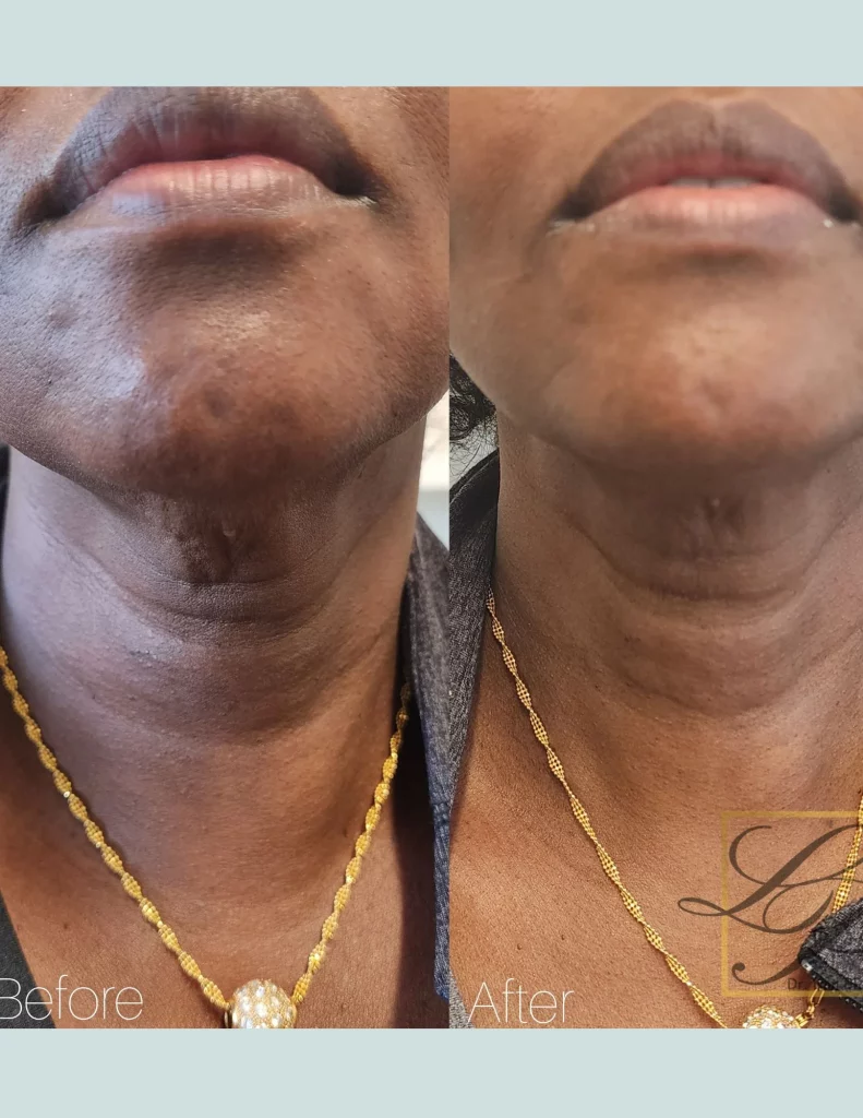 Before and After: RF Microneedling with Potenza after 2 Treatments