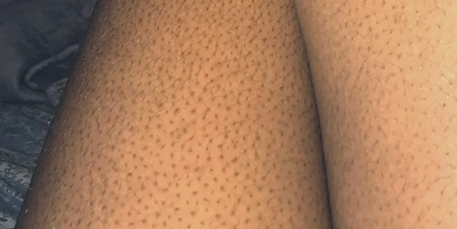 close up photo of a woman's strawberry thigh