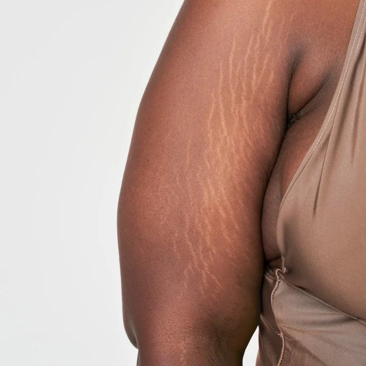 plus-size woman arm showing white stretch mark.