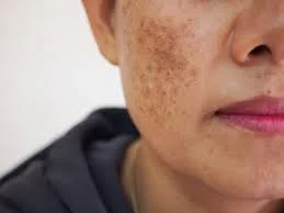 closeup of cheek with melasma spots