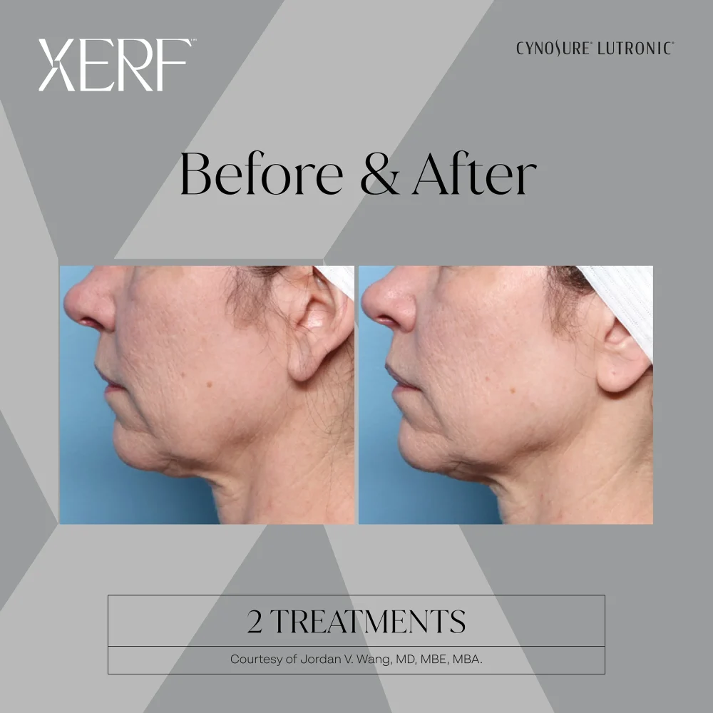 before & after photos: XERF facial skin tightening treatment