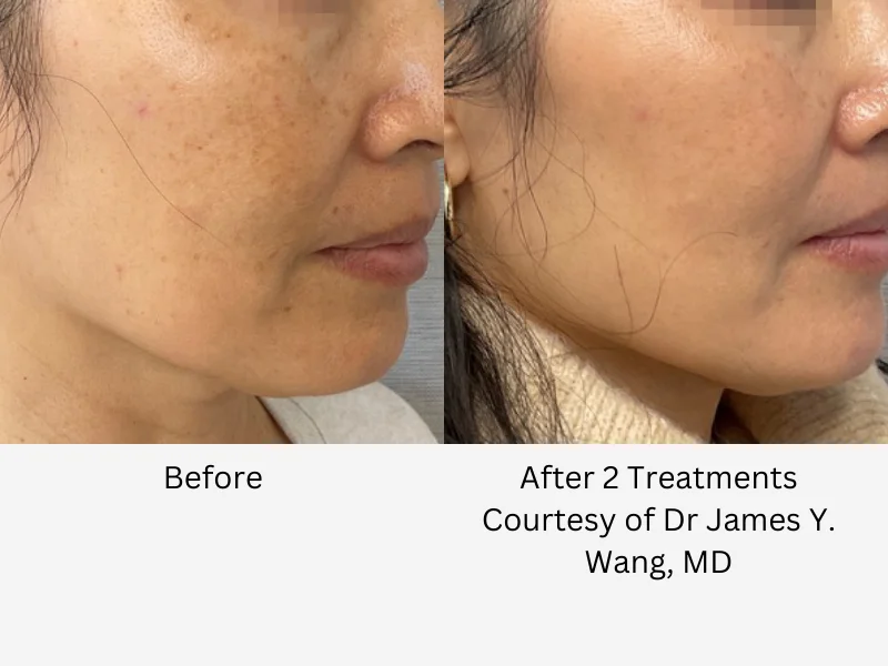 Laser skin resurfacing before and after photos : laser facial after 2 treatments with Cynosure Lutronic ULTRA 