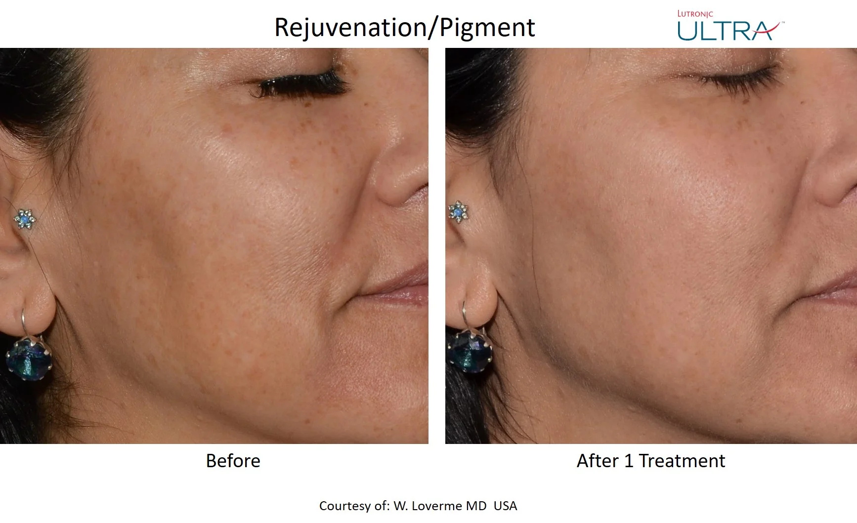 Before and after for laser skin resurfacing treatment: ultra laser facial resurfacing
