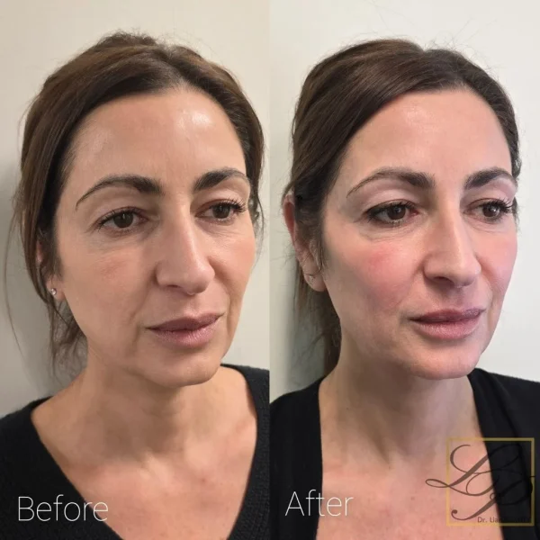 Before and After Ultra LaseMD Greek middle aged woman at Dr. Lian Beauty Clinic in Limoges, Eastern Ontario
