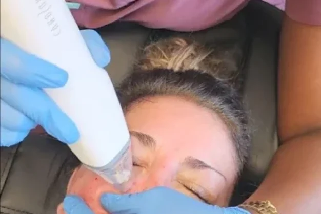 Woman undergoing potenza microneedling treatment with fusion tip